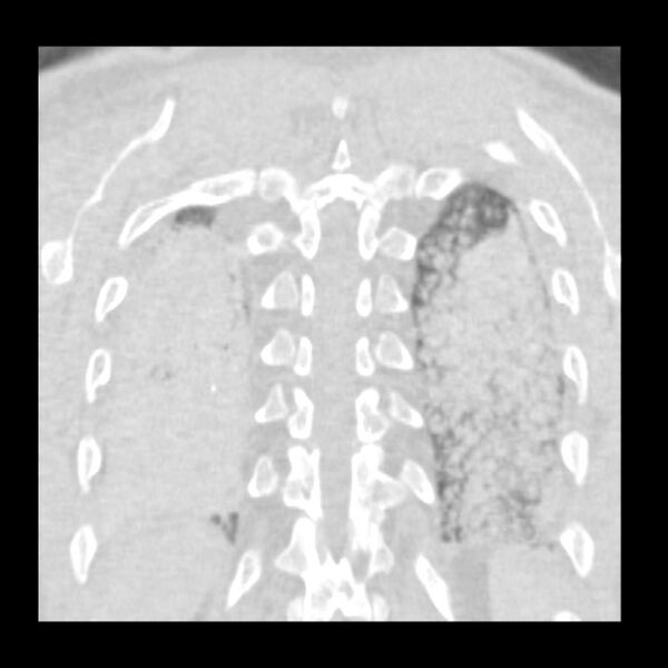 File:Acute diffuse alveolar hemorrhage (Radiopaedia 41323-44158 Coronal lung window 50).jpg