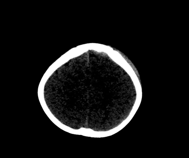File:Acute epidural hematoma (Radiopaedia 63659-72335 Axial subdural window 19).jpg
