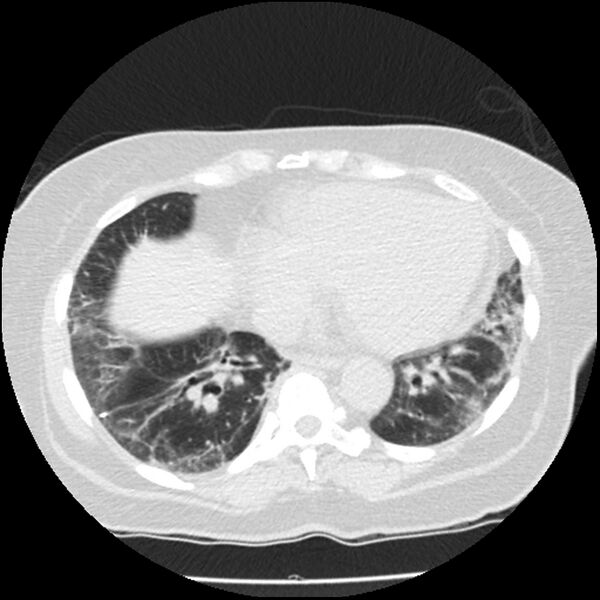 File:Acute interstitial pneumonitis (Radiopaedia 45404-49444 Axial lung window 72).jpg