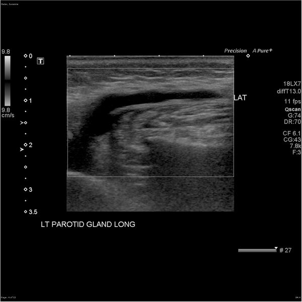 File:Acute left parotid sialadenitis (Radiopaedia 26160-26296 A 4).jpg