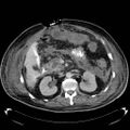 Acute pancreatic necrosis (Radiopaedia 13560-18503 Axial C+ portal venous phase 31).jpg