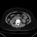 Acute pancreatitis - Balthazar C (Radiopaedia 26569-26714 Axial non-contrast 46).jpg