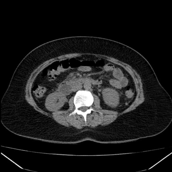 File:Acute pancreatitis - Balthazar C (Radiopaedia 26569-26714 Axial non-contrast 46).jpg