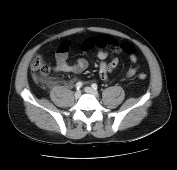 File:Acute pancreatitis - Balthazar E (Radiopaedia 23080-23110 Axial C+ portal venous phase 48).jpg