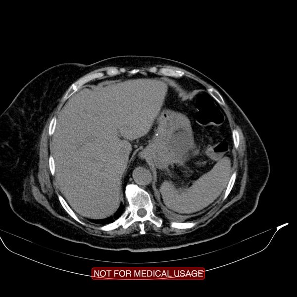 File:Acute pancreatitis with infected necrosis (Radiopaedia 26454-26585 Axial non-contrast 2).jpg