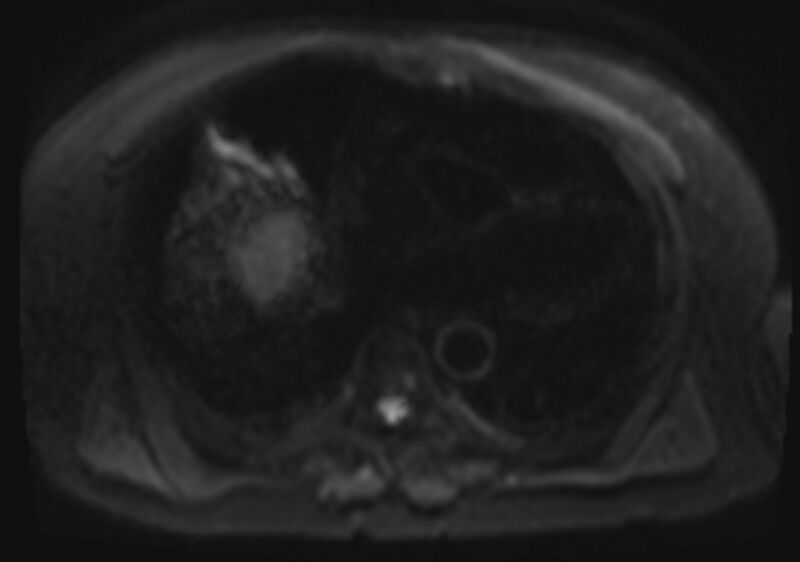 File:Acute portal vein thrombosis (Radiopaedia 73198-83925 Axial DWI 4).jpg