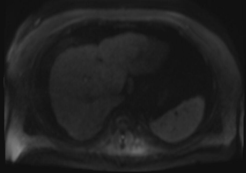Acute portal vein thrombosis (Radiopaedia 73198-83925 Axial DWI 70).jpg