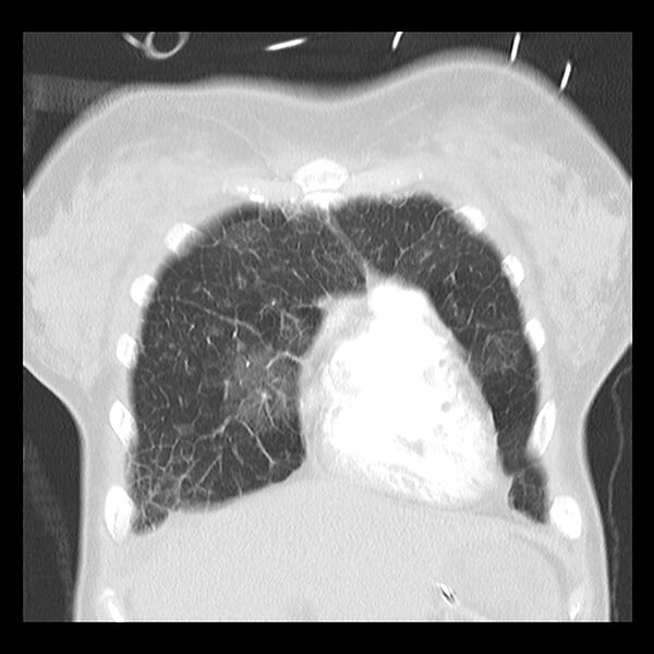 File:Acute pulmonary edema on CT (Radiopaedia 33582-34672 Coronal lung window 6).jpg