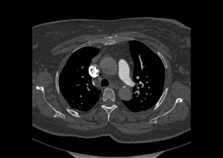 Acute pulmonary embolism (Radiopaedia 29938-30466 Axial C+ CTPA 15).jpg