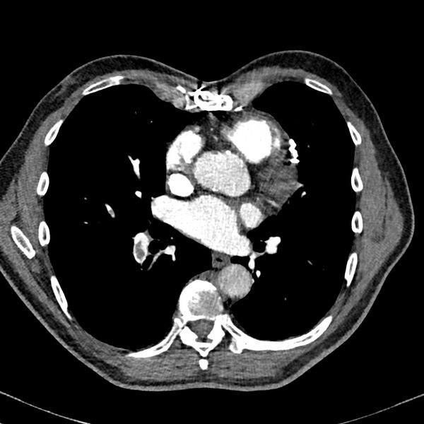File:Acute pulmonary embolism (Radiopaedia 81677-95570 Axial C+ CTPA 65).jpg