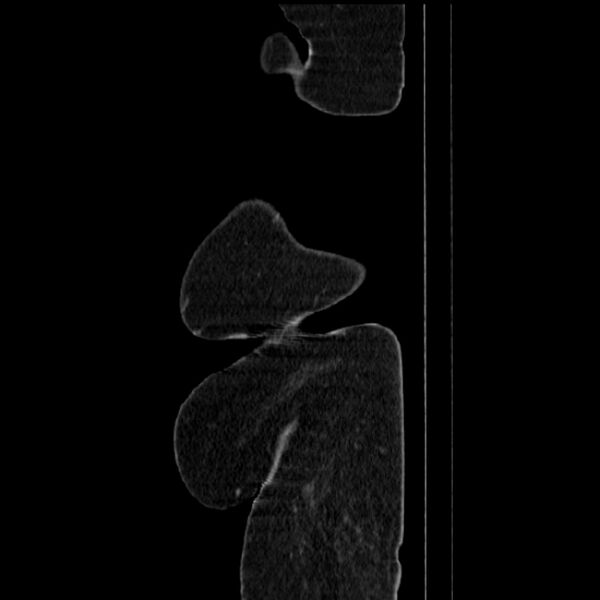 File:Acute pyelonephritis (Radiopaedia 25657-25837 Sagittal renal parenchymal phase 79).jpg