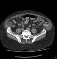 Acute renal failure post IV contrast injection- CT findings (Radiopaedia 47815-52557 Axial non-contrast 57).jpg