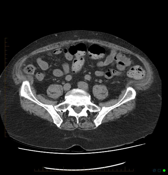 File:Acute renal failure post IV contrast injection- CT findings (Radiopaedia 47815-52557 Axial non-contrast 57).jpg