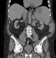 Acute renal failure post IV contrast injection- CT findings (Radiopaedia 47815-52557 Coronal non-contrast 26).jpg