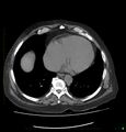 Acute renal failure post IV contrast injection- CT findings (Radiopaedia 47815-52559 Axial C+ portal venous phase 6).jpg