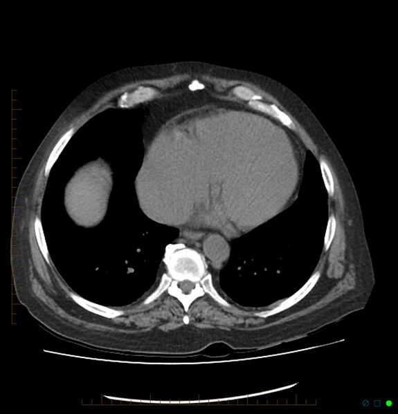File:Acute renal failure post IV contrast injection- CT findings (Radiopaedia 47815-52559 Axial C+ portal venous phase 6).jpg