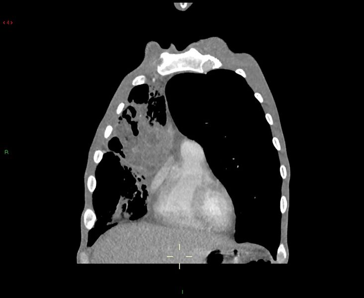 File:Acute right lung abscess (Radiopaedia 34806-36258 Coronal C+ arterial phase 45).jpg