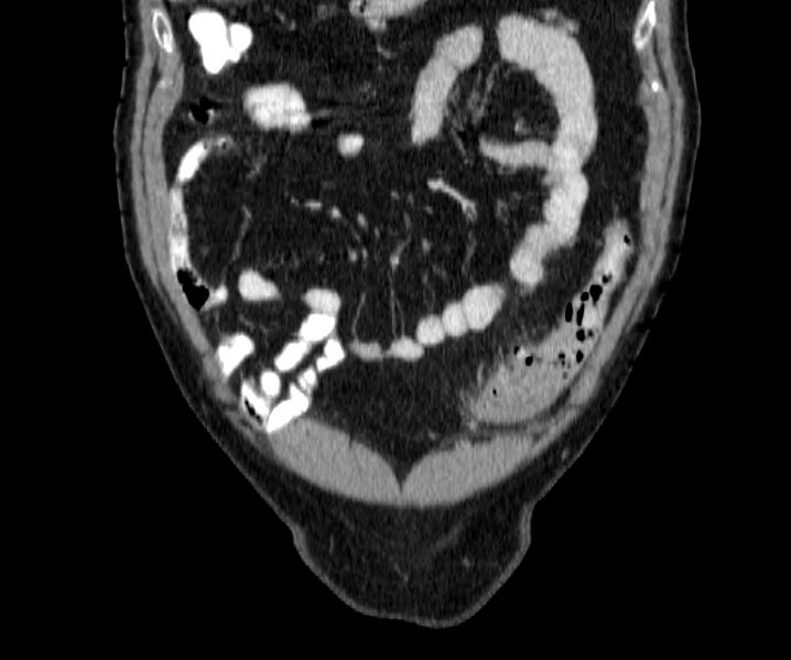 File:Acute sigmoid colon diverticulitis (Radiopaedia 55507-61976 Coronal C+ portal venous phase 17).jpg