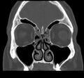 Acute sinusitis (Radiopaedia 23161-23215 Coronal bone window 31).jpg
