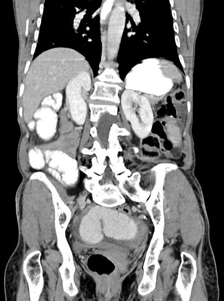 File:Acute small bowel (ileal) volvulus (Radiopaedia 71740-82139 Coronal C+ portal venous phase 76).jpg