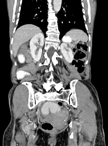File:Acute small bowel (ileal) volvulus (Radiopaedia 71740-82139 Coronal C+ portal venous phase 82).jpg