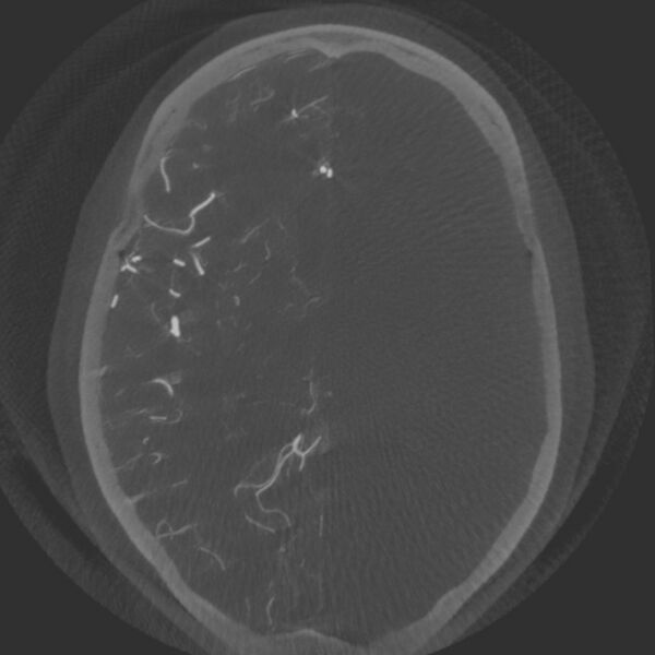 File:Acute subarachnoid hemorrhage and accessory anterior cerebral artery (Radiopaedia 69231-79010 Axial arterial - MIP 42).jpg