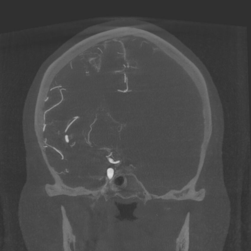 Acute subarachnoid hemorrhage and accessory anterior cerebral artery (Radiopaedia 69231-79010 Coronal arterial - MIP 47).jpg