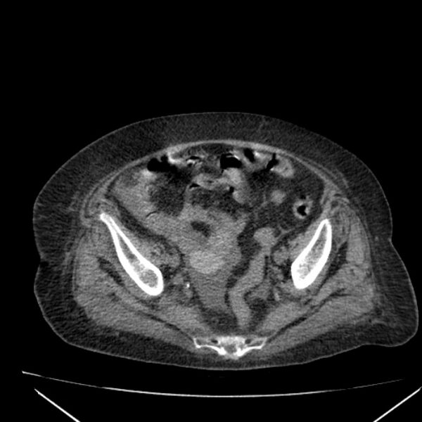 File:Acute tubular necrosis (Radiopaedia 28077-28334 Axial non-contrast 57).jpg