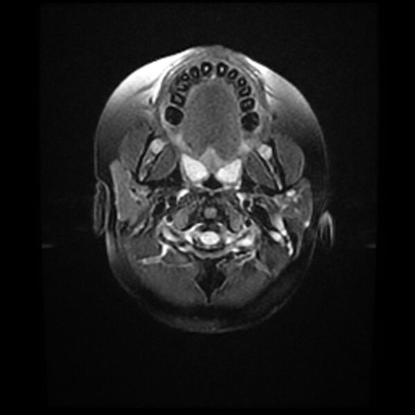 File:Adamantinomatous craniopharyngioma (Radiopaedia 77407-89529 Axial FLAIR 1).jpg
