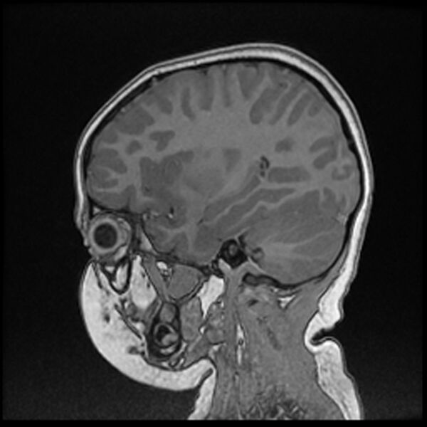 File:Adamantinomatous craniopharyngioma (Radiopaedia 77407-89529 Sagittal T1 C+ 94).jpg