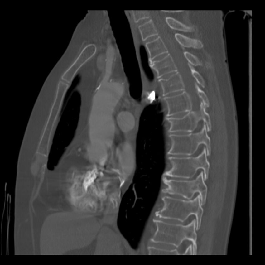 Adenocarcinoma of the lung (Radiopaedia 41015-43755 Sagittal bone window 51).jpg