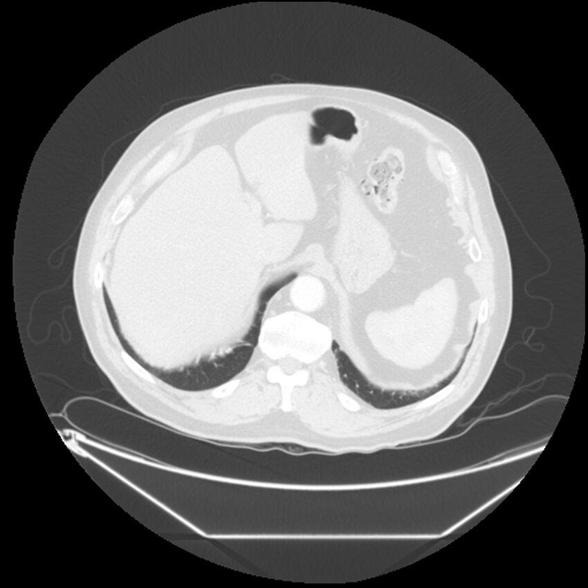 Adenocarcinoma of the lung (Radiopaedia 44876-48759 Axial lung window 73).jpg