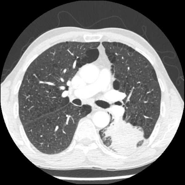 File:Adenocarcinoma of the lung - micropapillary predominant (Radiopaedia 42446-45563 C 33).jpg