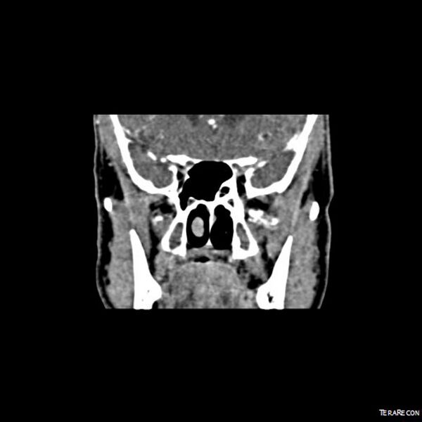 File:Adenoid cystic carcinoma involving paranasal sinus (Radiopaedia 16580-16283 Coronal C+ arterial phase 1).jpeg