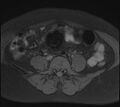 Adenomyosis - ovarian endometriomas (Radiopaedia 67031-76350 Axial T1 fat sat 3).jpg