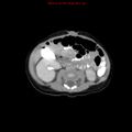 Adrenal hemorrhage (Radiopaedia 9390-10077 Axial C+ portal venous phase 20).jpg