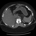 Adrenal myelolipoma (Radiopaedia 8216-9068 Axial non-contrast 8).jpg