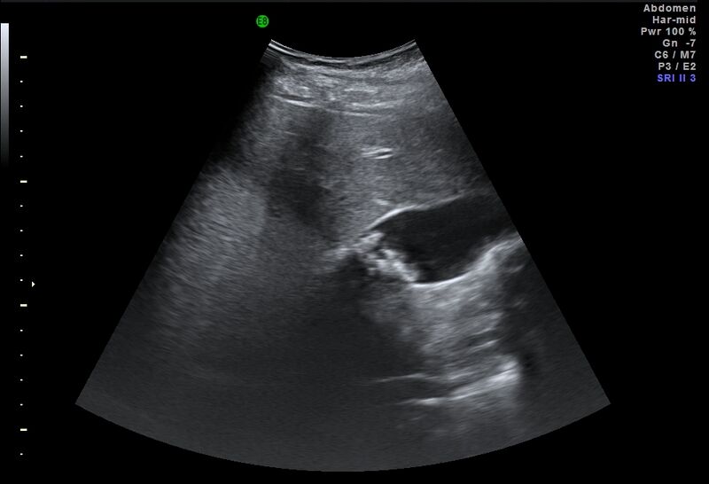 File:Adrenal myelolipoma - bilateral (Radiopaedia 74805-85811 Abdominal ultrasound 10).jpg