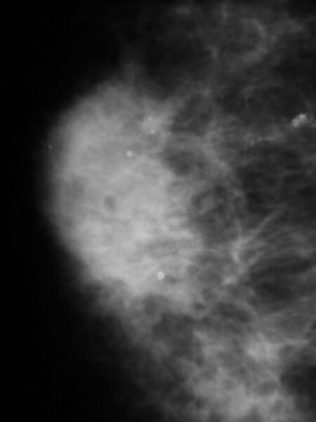 File:Advanced breast cancer (Radiopaedia 14931-14870 CC 1).jpg