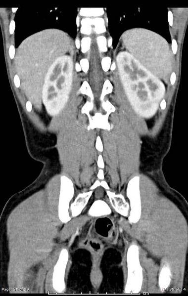 File:Agenesis of the gallbladder (Radiopaedia 55454-61905 A 38).jpg
