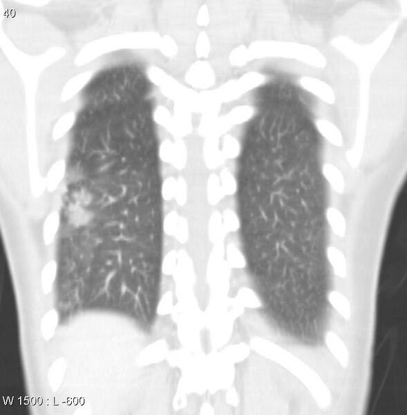 File:Air crescent sign (aspergilloma) (Radiopaedia 14380-14306 Coronal lung window 7).jpg