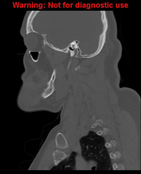 File:Ameloblastoma (Radiopaedia 33126-34164 Sagittal bone window 53).jpg