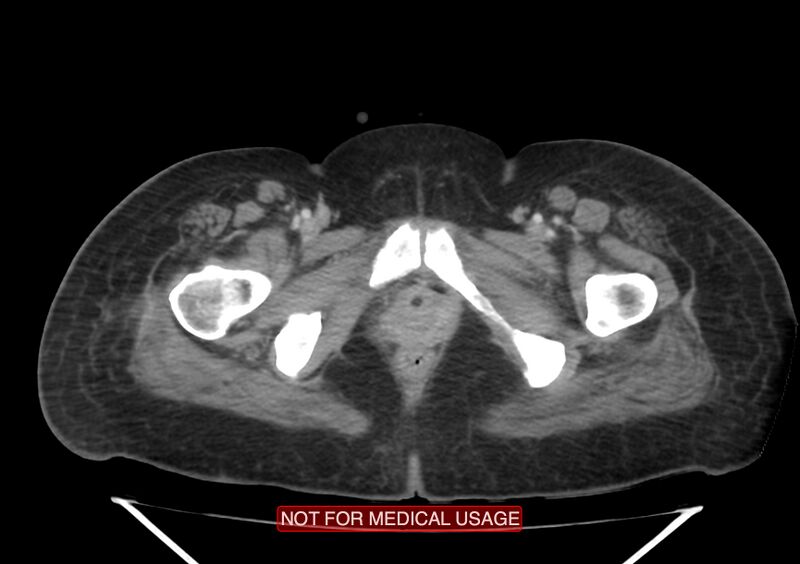 File:Amoebic enterocolitis with liver abscess (Radiopaedia 35100-36609 A 84).jpg