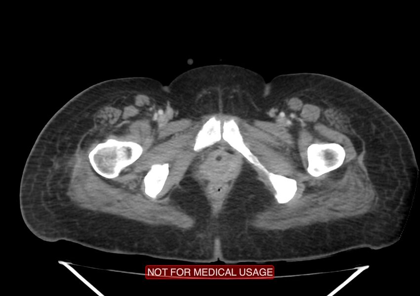 Amoebic enterocolitis with liver abscess (Radiopaedia 35100-36609 A 84).jpg