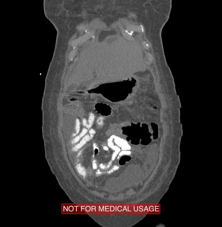 Amoebic enterocolitis with liver abscess (Radiopaedia 35100-36609 B 13).jpg