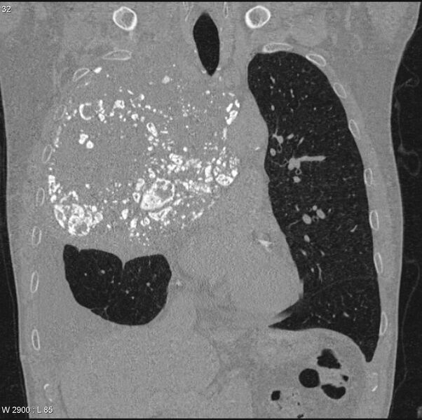 File:Amyloidoma - mediastinal (Radiopaedia 6711-7925 Coronal bone window 6).jpg