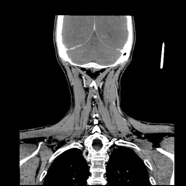 File:Anaplastic thyroid carcinoma (Radiopaedia 79087-92034 A 93).jpg