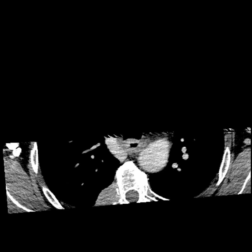 Anaplastic thyroid carcinoma (Radiopaedia 79087-92034 B 1).jpg