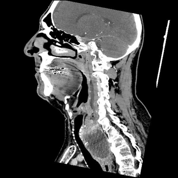 File:Anaplastic thyroid carcinoma (Radiopaedia 79087-92034 C 53).jpg