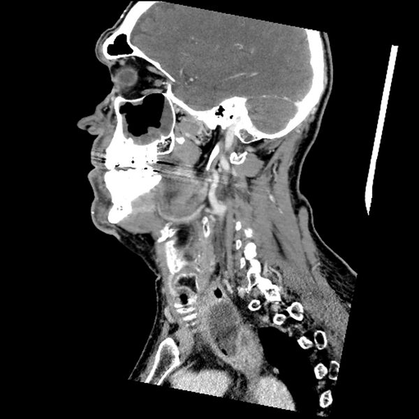 File:Anaplastic thyroid carcinoma (Radiopaedia 79087-92034 C 61).jpg